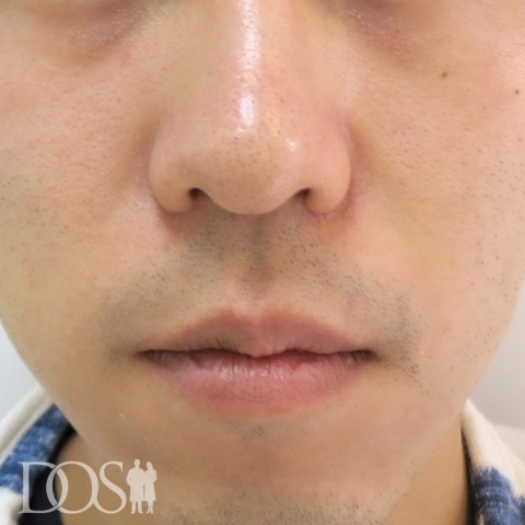 当院患者さま（20代）：小鼻：施術後