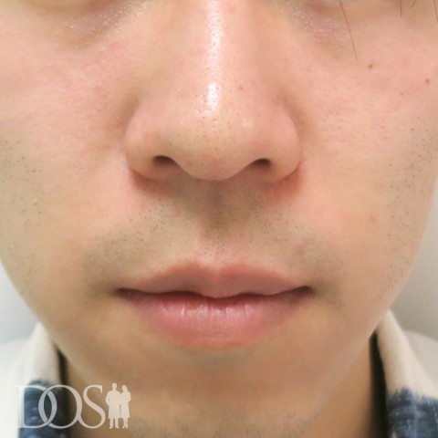 当院患者さま（20代）：小鼻：施術前