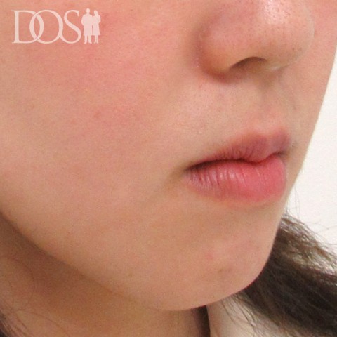 当院スタッフ（20代）：あご：施術前