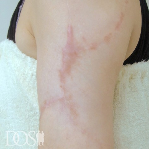 当院患者さま：上腕のタトゥー：施術後