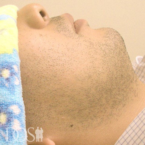 当院患者さま：ヒゲ脱毛：施術前