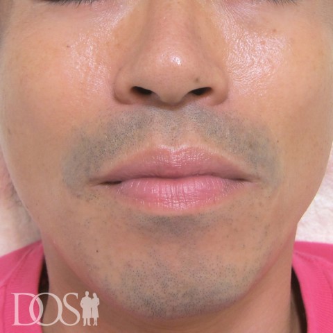 当院患者さま（岡本あきらさん）：ヒゲ脱毛：施術前