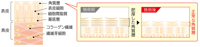 正常な皮膚の構図