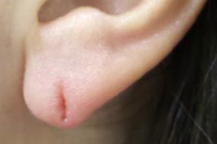 耳垂裂形成術