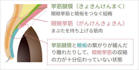 眼瞼下垂の説明
・挙筋腱膜:眼瞼挙筋と瞼板をつなぐ組織
・眼瞼挙筋:まぶたを持ち上げる筋肉
・挙筋腱膜と瞼板の繋がりが緩んだり離れたりして、眼瞼挙筋の収縮の力が十分伝わっていない状態
