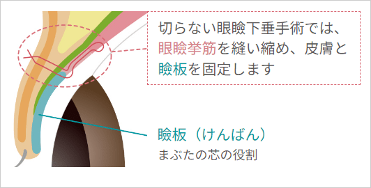 切らない眼瞼下垂手術では、眼瞼挙筋を縫い縮め、皮膚と瞼板を固定します
・瞼板:まぶたの芯の役割