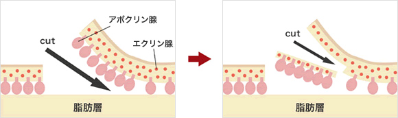 福岡(博多)・広島の「男たちの美容外科」が実施する反転剪除法(はんてんせんじょほう)のイメージ