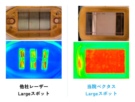 他社レーザーのLargeスポットと福岡(博多)・広島の「男たちの美容外科」が使用するベクタスのLargeスポットの照射面の比較画像