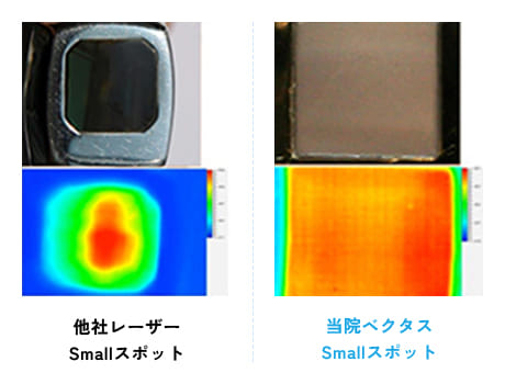 他社レーザーのSmallスポットと福岡(博多)・広島の「男たちの美容外科」が使用するベクタスのSmallスポットの照射面の比較画像