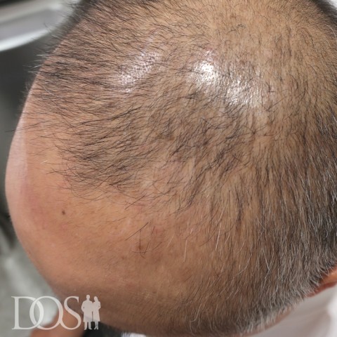47歳 男性 AGA発毛事例：施術後