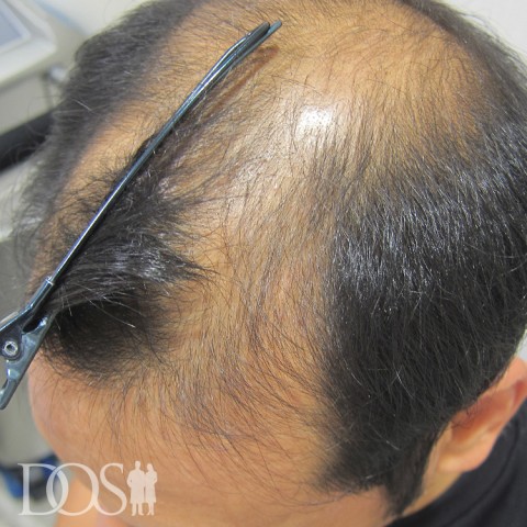 36歳 男性 AGA発毛事例：施術前
