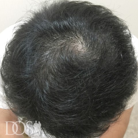 20代 男性 AGA発毛事例：施術後
