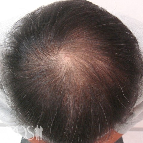 54歳 男性 AGA発毛事例の症例写真（3ヶ月後（頭頂部））
