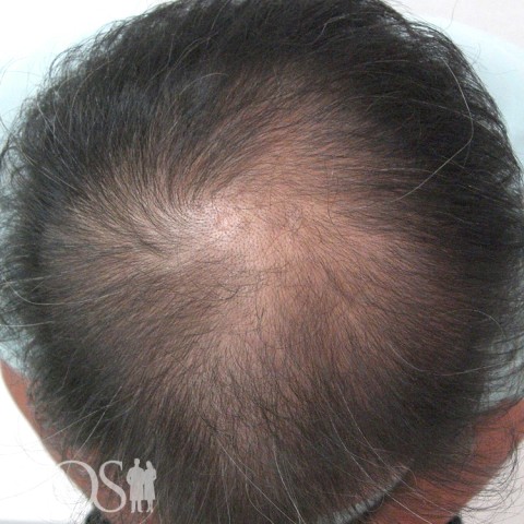 54歳 男性 AGA発毛事例：施術前
