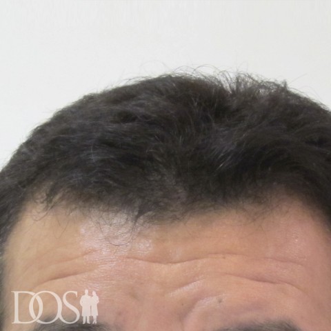 52歳 男性 AGA発毛事例の症例写真（3ヶ月後（前頭部））