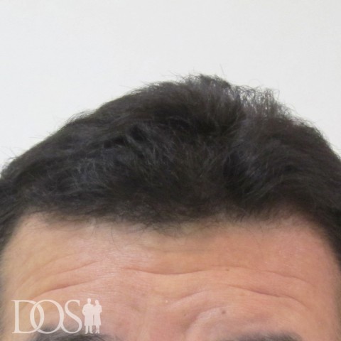 52歳 男性 AGA発毛事例の症例写真（6ヶ月後（前頭部））