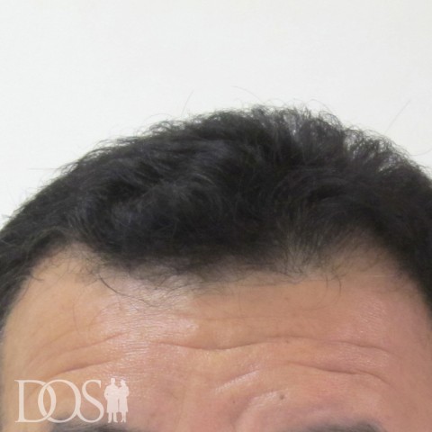 52歳 男性 AGA発毛事例の症例写真（before（前頭部））