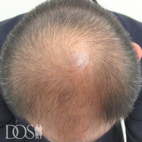 40代 男性 AGA発毛事例：施術前