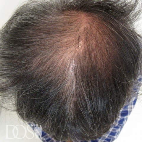 50歳 男性 AGA発毛事例：施術前
