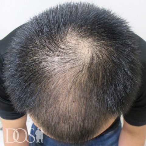 30代 男性 AGA発毛事例：施術前