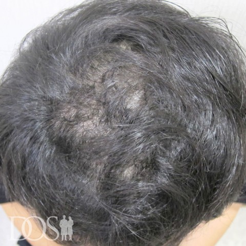 30代 男性 AGA発毛事例：施術後