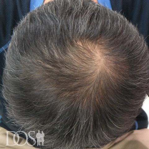 50歳 男性 AGA発毛事例：施術前