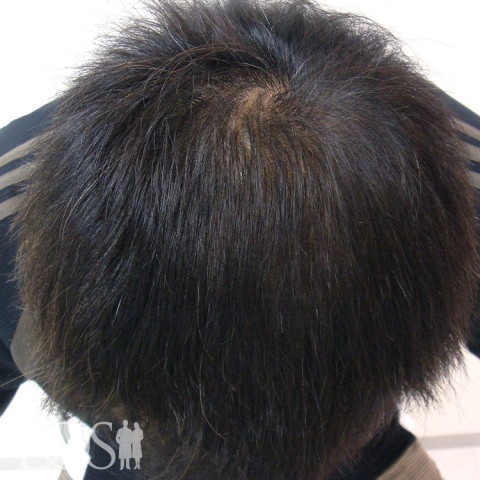 40代 タレントT 男性 AGA発毛事例：施術後