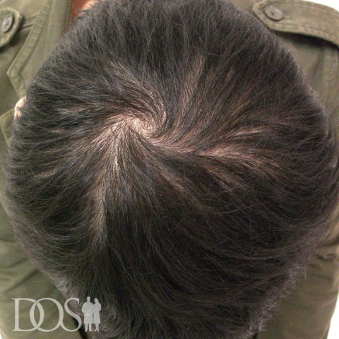 23歳 男性 AGA発毛事例：施術前