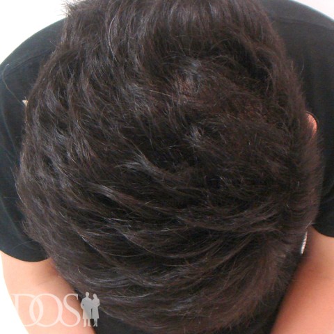 28歳 男性 AGA発毛事例：施術後
