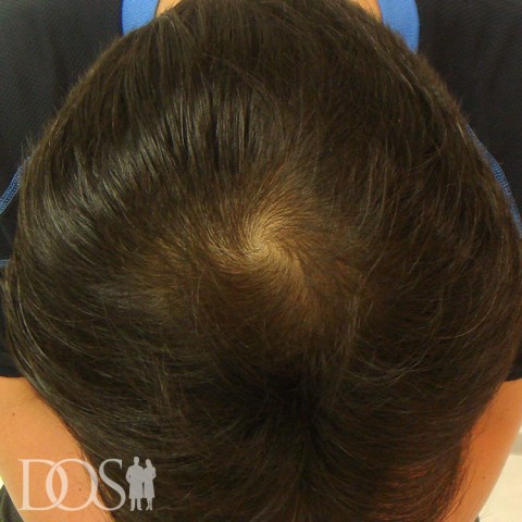 36歳 男性 AGA発毛事例の症例写真（3ヶ月後（頭頂部））