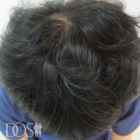 39歳 男性 AGA発毛事例：施術後