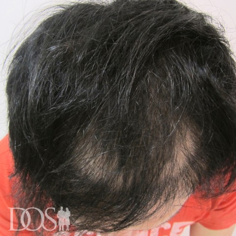 31歳 男性 AGA発毛事例：施術後