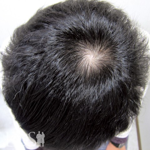 20代後半 男性 AGA発毛事例：施術後