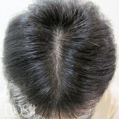50歳 男性 AGA発毛事例：施術前