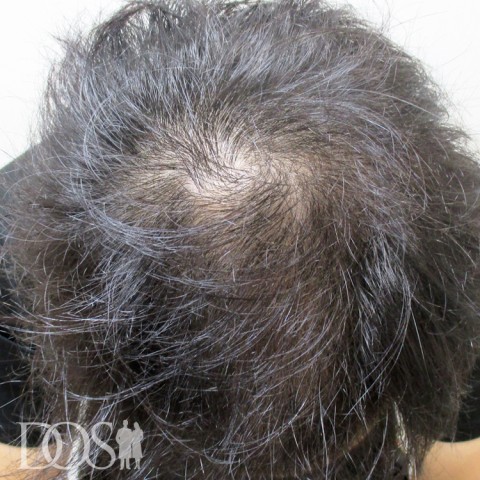 33歳 男性 AGA発毛事例の症例写真（3ヶ月後（頭頂部））