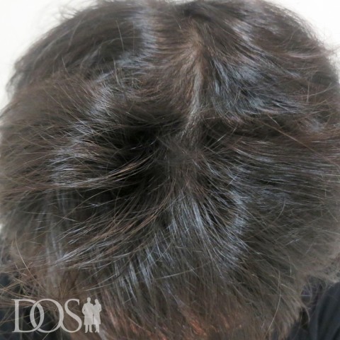 30代 男性 AGA発毛事例：施術後