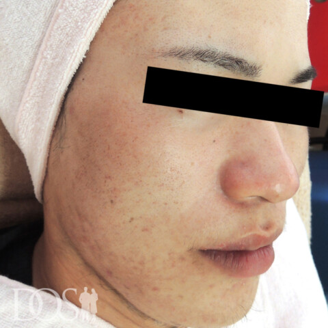 当院患者さま（23歳）：ニキビ・ニキビ痕：施術後