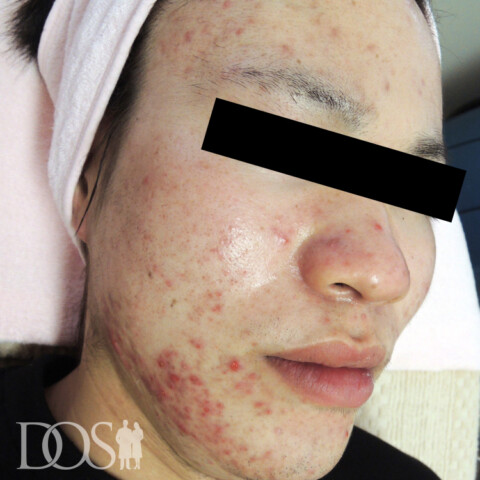 当院患者さま（23歳）：ニキビ・ニキビ痕：施術前