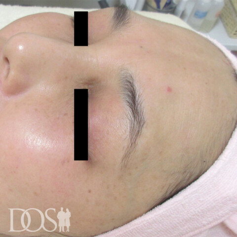 当院患者さま（50代）：しみ・肝斑：施術後