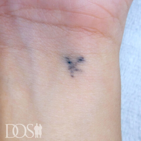 当院患者さま：手首のタトゥー：施術前